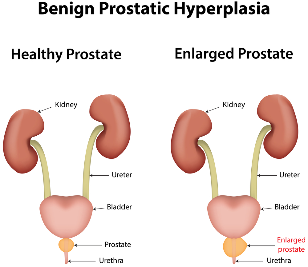 hiperplázia a prostatitis alatt