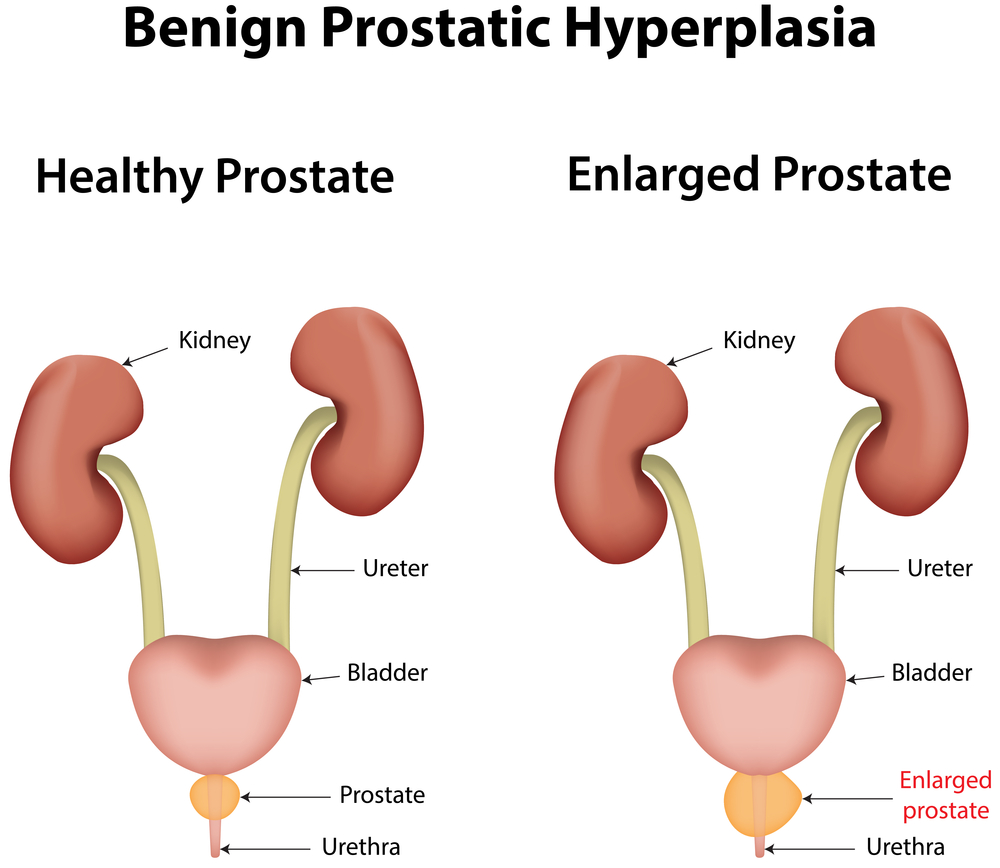 Prostate Artery Embolization As An Efefctive Treatment for Benign Prostatic Hyperplasia