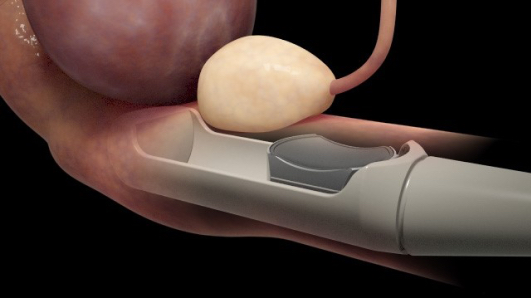 Sonablate, a Minimally Invasive Prostate Tissue Ablation Device, Used for 1st Time in Texas