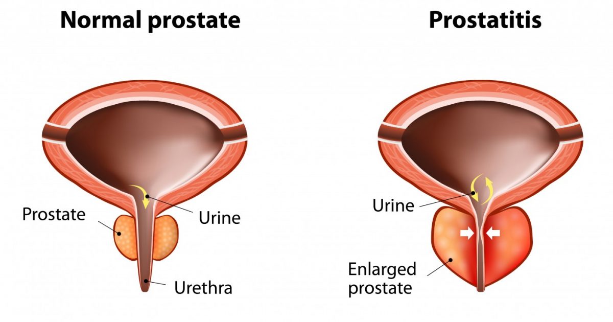 Prostatitis vizelet vérrel a férfiaknál, A prosztata olyan, akár egy dió