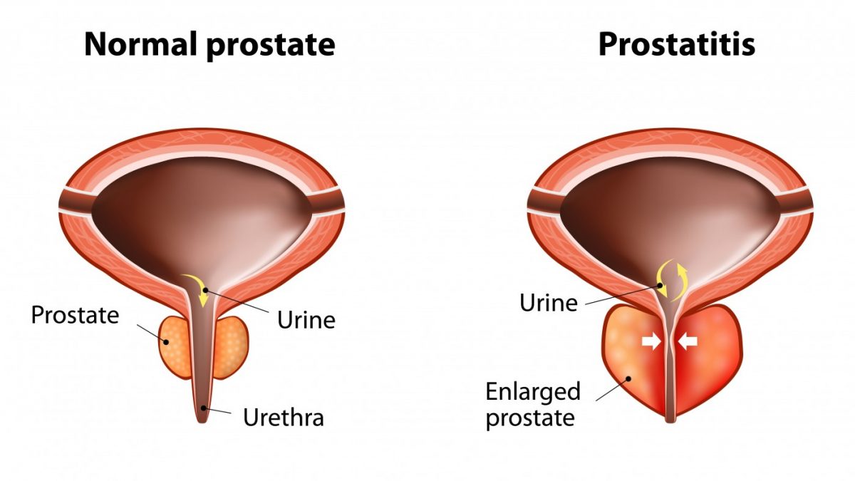 prostatitis és benthos vélemények shah így a prostatitis