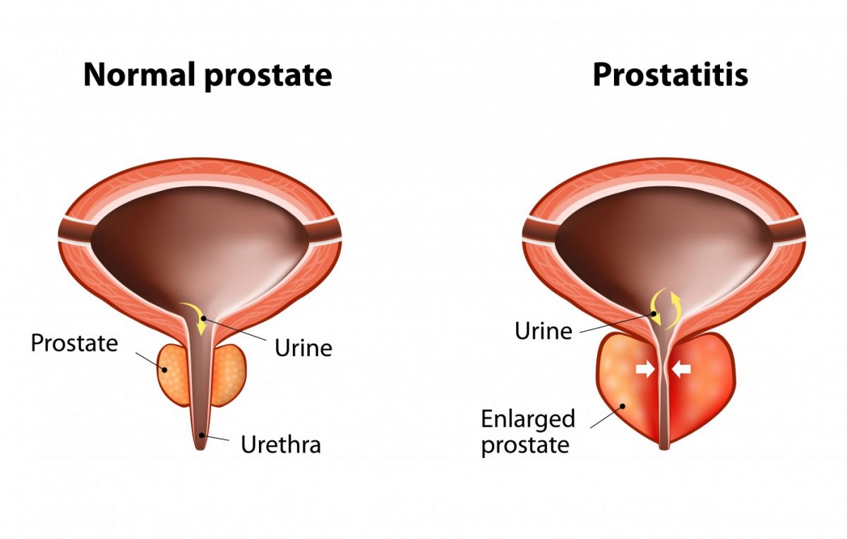 prostate infection test name)