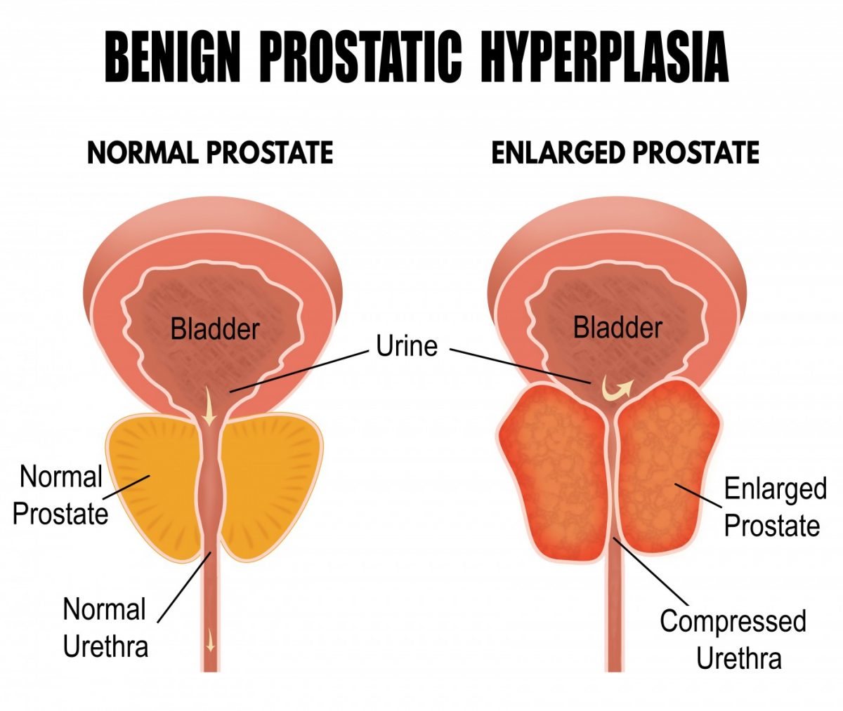 Prostatitis hiperplázia)