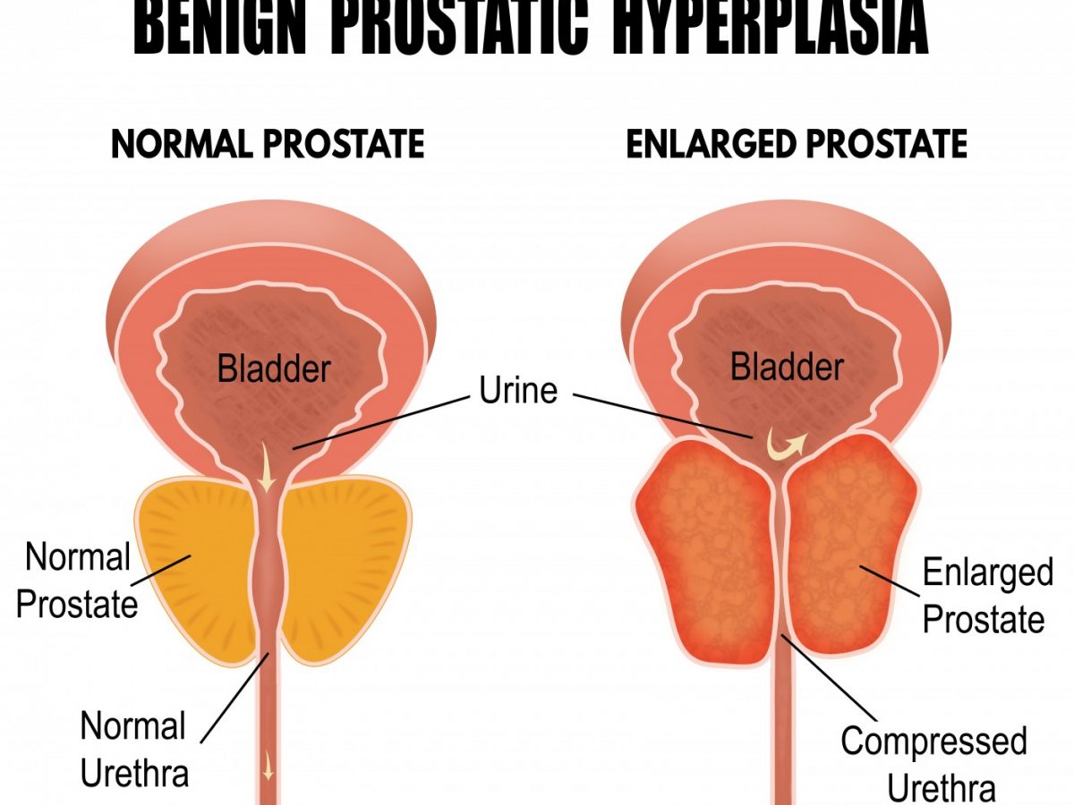 prostatic hyperplasia meaning