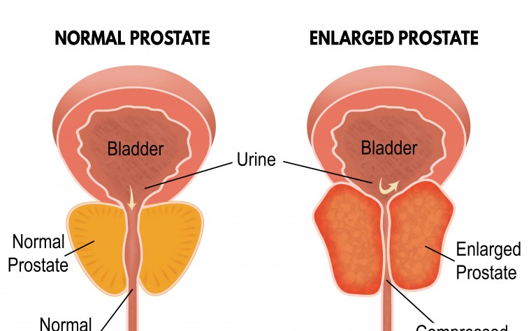 Benign Prostatic Hyperplasia (BPH)