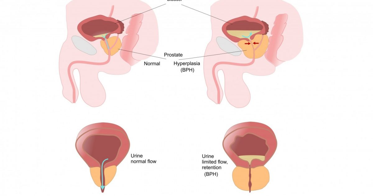 In Benign Prostatic Hyperplasia Decrease In Oxygen To Tissues Is