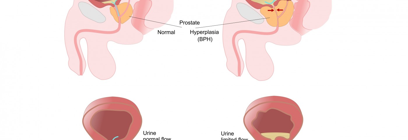 In Benign Prostatic Hyperplasia, Decrease in Oxygen to Tissues Is Linked to Urinary Retention