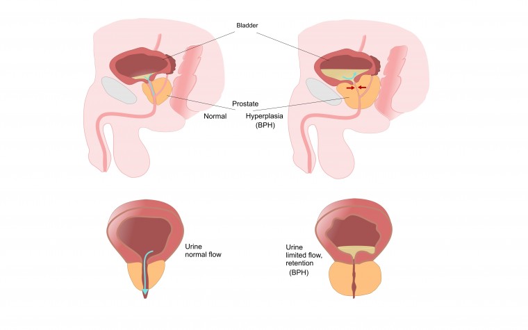 does flomax cause urinary retention