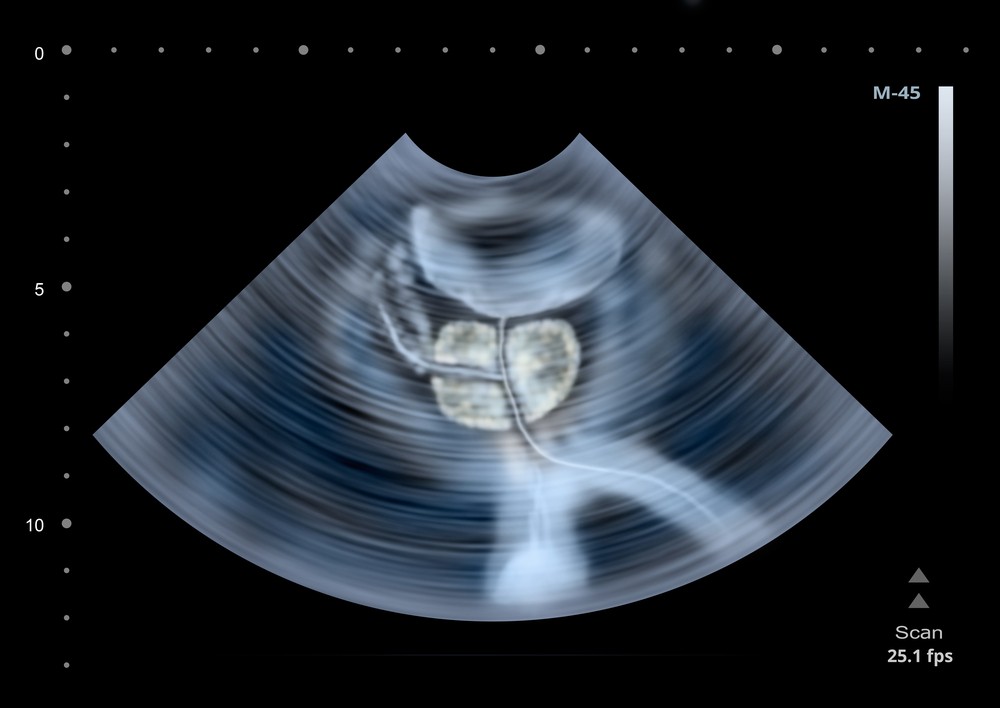 benign prostatic hyperplasia ultrasound classification)