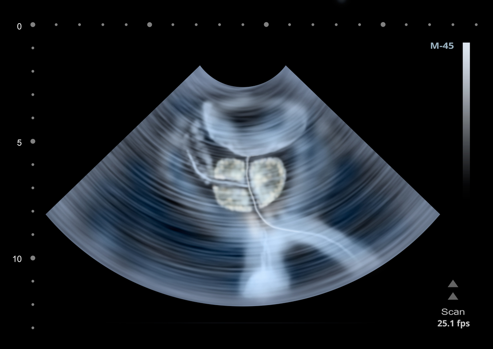 Likely BPH Progression May Be Predicted by Person's IPP 