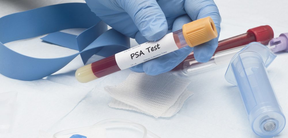 Diagnosis of Prostate Cancer Requires Tests Beyond Total PSA Value
