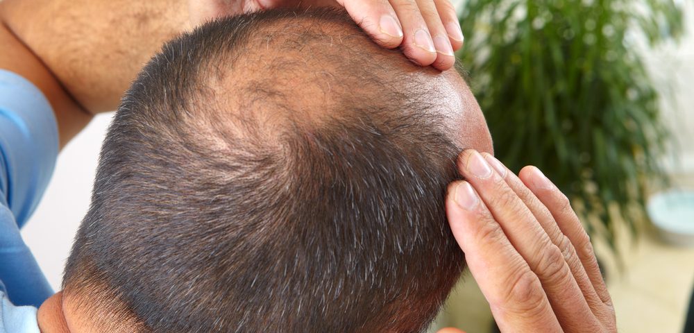 Male Baldness Likely an Early Warning of BPH in Later Years, Study Says