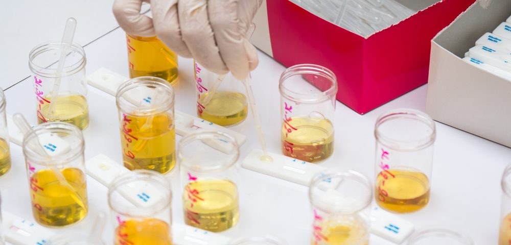 Urine Protein Analysis Can Be Invaluable for Studying BPH